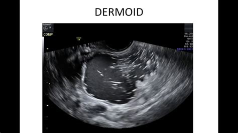 adnexal mass ultrasound